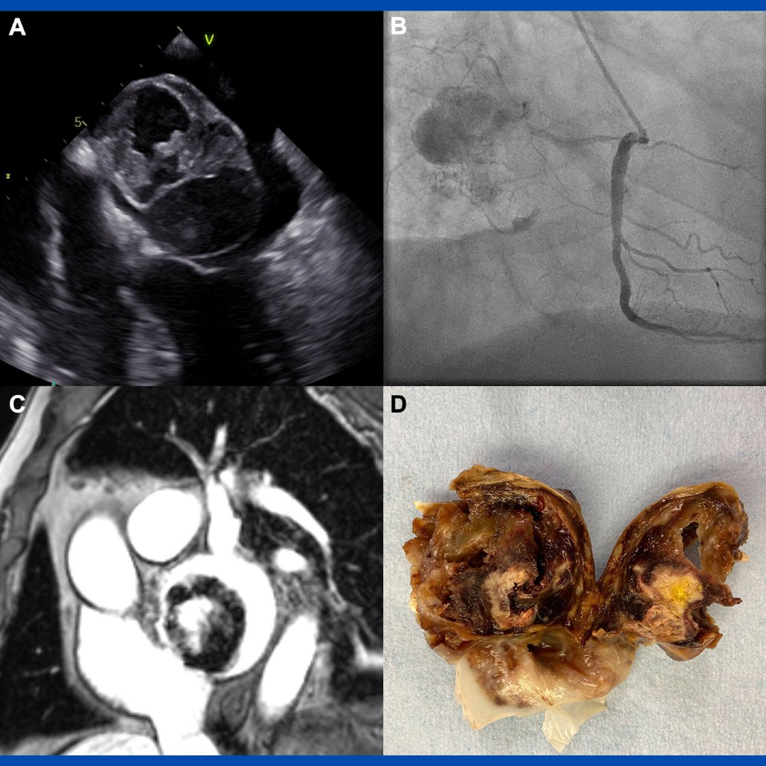 Learn the challenging case of a 67 y/o man that from an elective surgery discovered a cardiac tumor. bit.ly/3Mlsm6E

Would you have done it differently? 🤔

#JACCCaseReports #cvSurg #CathLab #CardioTwitter