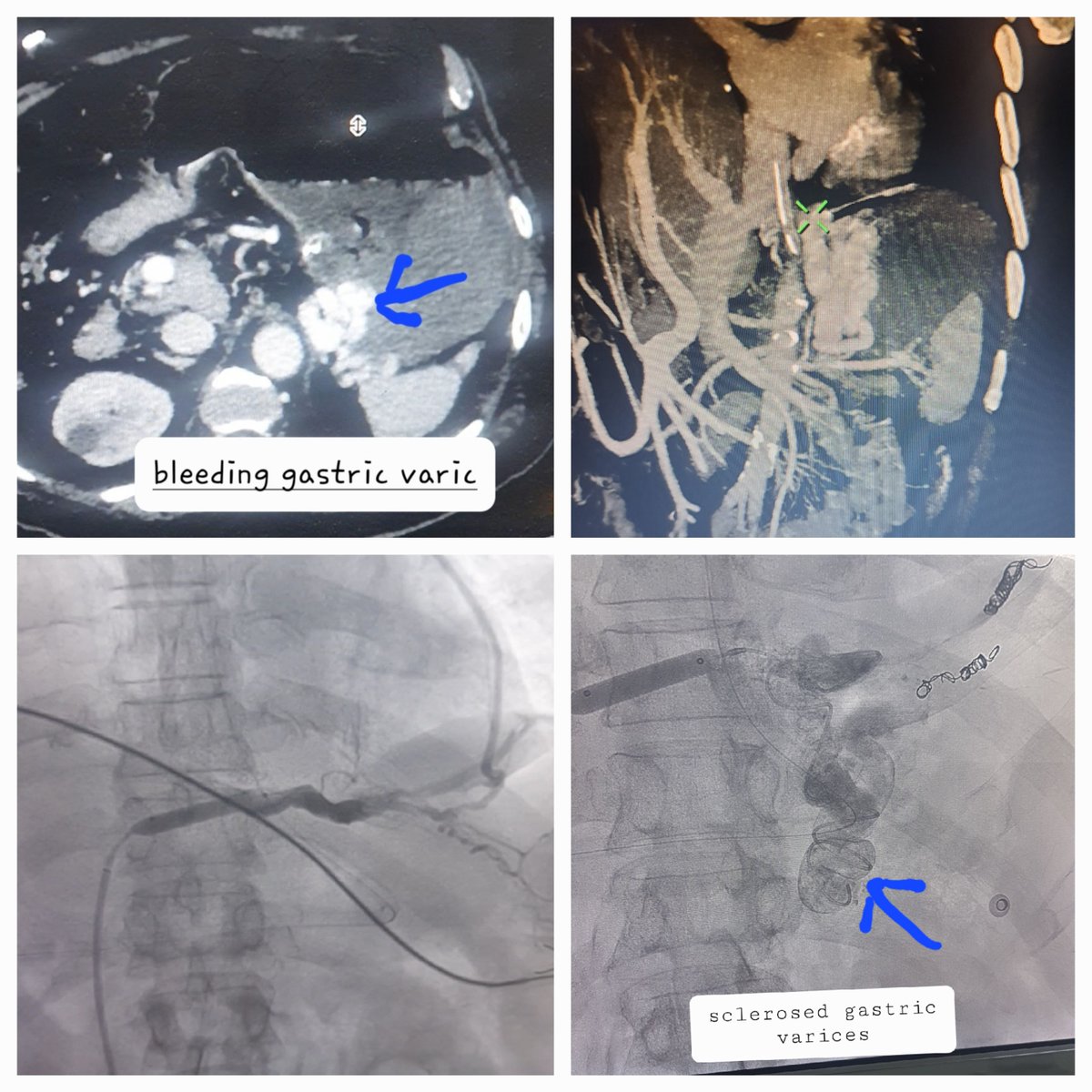 Dr Saurabh kumar Interventional radiologist tweet media