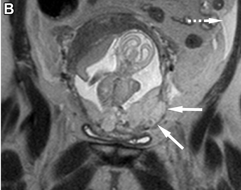 Recognize the MRI features of placenta accreta spectrum disorders, which are increasing in incidence with the rising rate of cesarean deliveries. bit.ly/3VK1gsE @VUMCradiology <a href="/KPatelLippmann/">Krupa Patel-Lippmann</a> <a href="/VPlanz/">Virginia Planz</a> <a href="/CatiePhillips1/">Catie Phillips, MD</a> @moshirimd @VUMC_obgyn