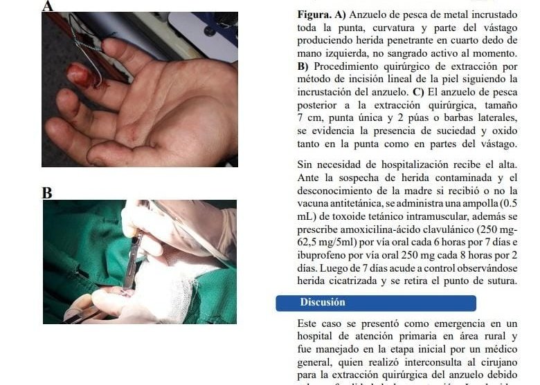 eliguaman97's tweet photo. "Las heridas por anzuelos de pescar son una emergencia común dentro de la práctica médica general y rural; sin embargo, su accionar suele ser desconocido. En este estudio describimos un caso clínico y una breve revisión de las técnicas de extracción"

👇
https://t.co/brRZ9iBfvF https://t.co/OFPtoT2htO