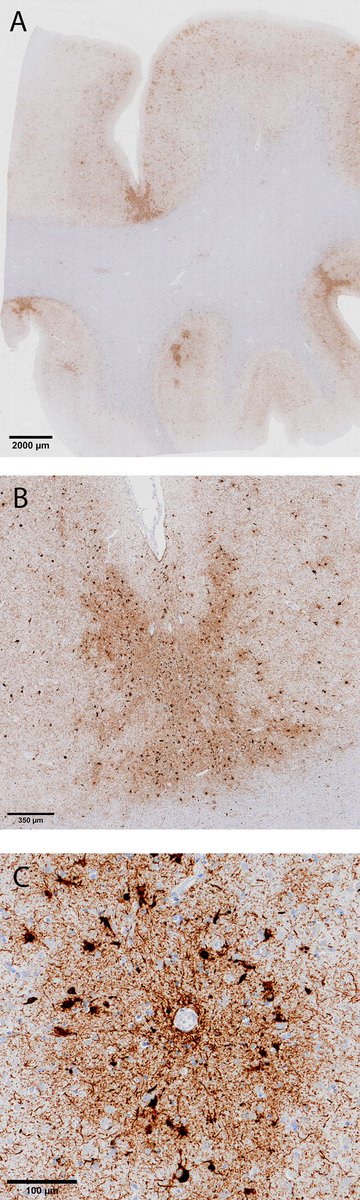 Check out NEwTON’s newest publication! Severe CTE and TDP-43 in a former professional soccer player. A pathological case report, supported by clinical and biomarker data. Great team effort from colleagues at @AlzheimerAms and @bu_cte actaneurocomms.biomedcentral.com/articles/10.11… #CTE