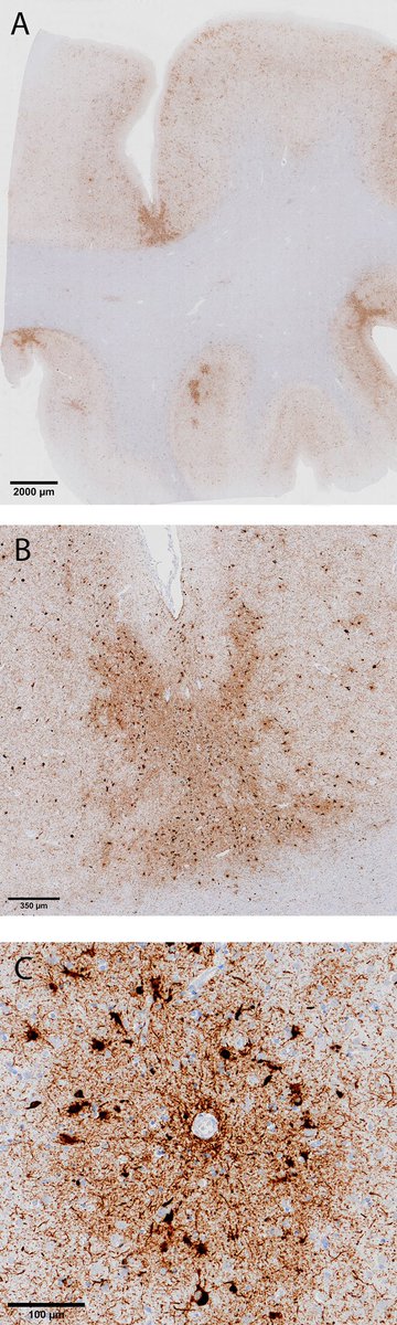 Check out our newest publication! Severe CTE and TDP-43 in a former professional soccer player. A pathological case report, supported by clinical and biomarker data. Great team effort from colleagues at <a href="/AlzheimerAms/">Alzheimercentrum Amsterdam (inactief)</a> and <a href="/bu_cte/">Boston University CTE Center</a> 

actaneurocomms.biomedcentral.com/articles/10.11…