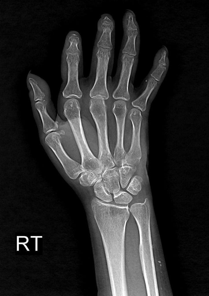 BrownJHM's tweet image. Patient presented with difficulty swallowing &amp;amp; abdominal pain. Diagnosis? (Images: Medbullets, Radiopaedia.com, Yair Glick) #medtwitter