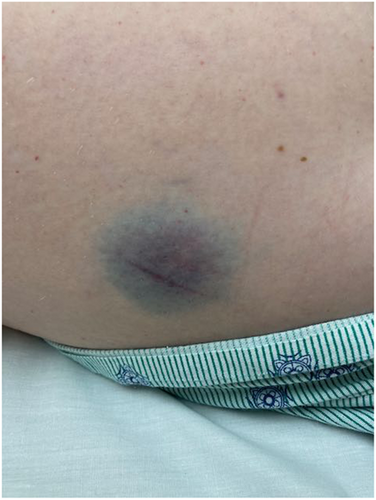 AdverseReports's tweet photo. Immune thrombocytopenia in 2 healthy young women after the #Pfizer-#mRNA BNT16B2b2
20-year-old woman 2nd dose
21-year-old woman 1st dose
https://t.co/WJFlWpnqVk https://t.co/psdZPzMsto