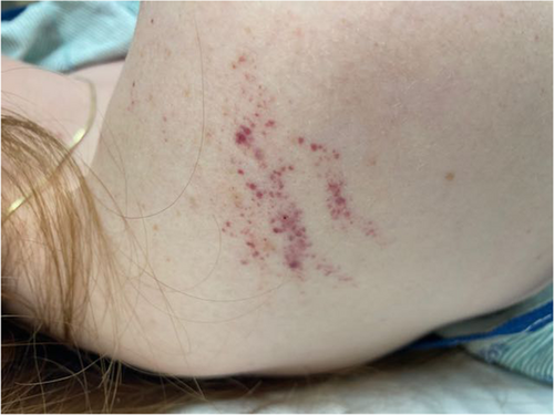 AdverseReports's tweet photo. Immune thrombocytopenia in 2 healthy young women after the #Pfizer-#mRNA BNT16B2b2
20-year-old woman 2nd dose
21-year-old woman 1st dose
https://t.co/WJFlWpnqVk https://t.co/psdZPzMsto