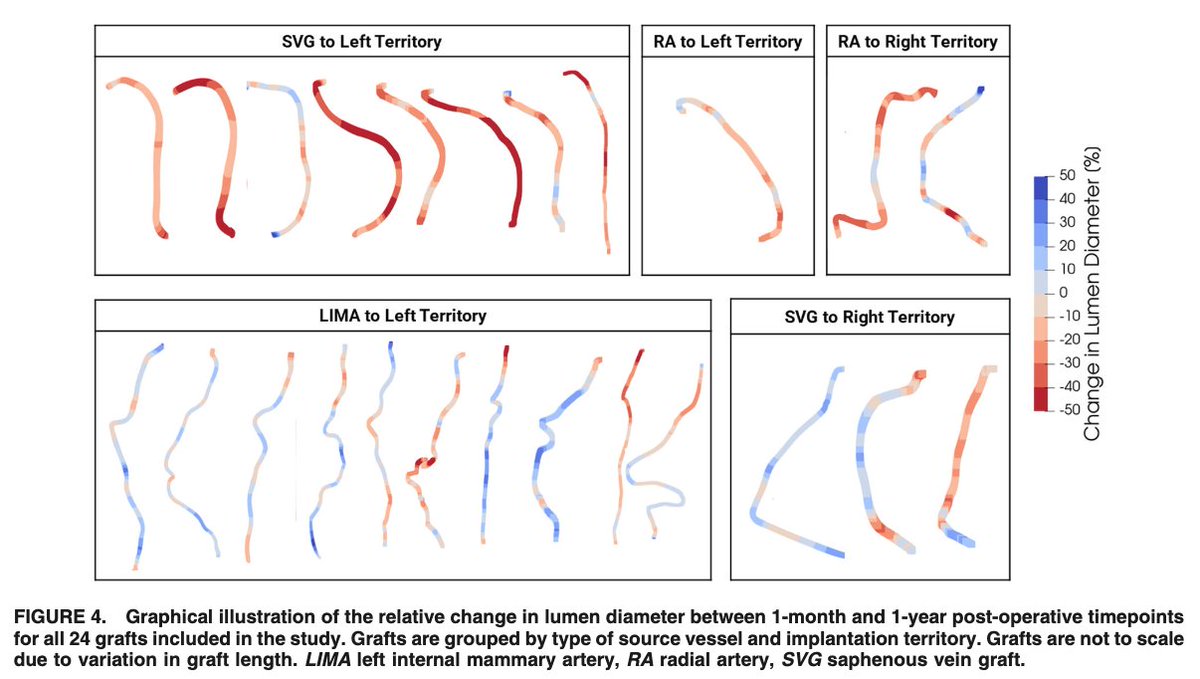 Nhien shows a new result potentially relevant to CABG failure: abnormal WSS area is correlated to graft remodeling 1y after surgery

link.springer.com/article/10.100…

with A. Yan, S. Fremes, <a href="/LJimenezJuan/">Laura Jimenez Juan</a> 

<a href="/RSNA/">RSNA</a> <a href="/bme_uoft/">Biomedical Engineering @ University of Toronto</a> 
<a href="/eceuoft/">ECE U of T</a> @uoftengineering <a href="/UofT/">University of Toronto</a>
<a href="/Sunnybrook/">Sunnybrook Health Sciences Centre</a>
<a href="/UnityHealthTO/">Unity Health Toronto</a>