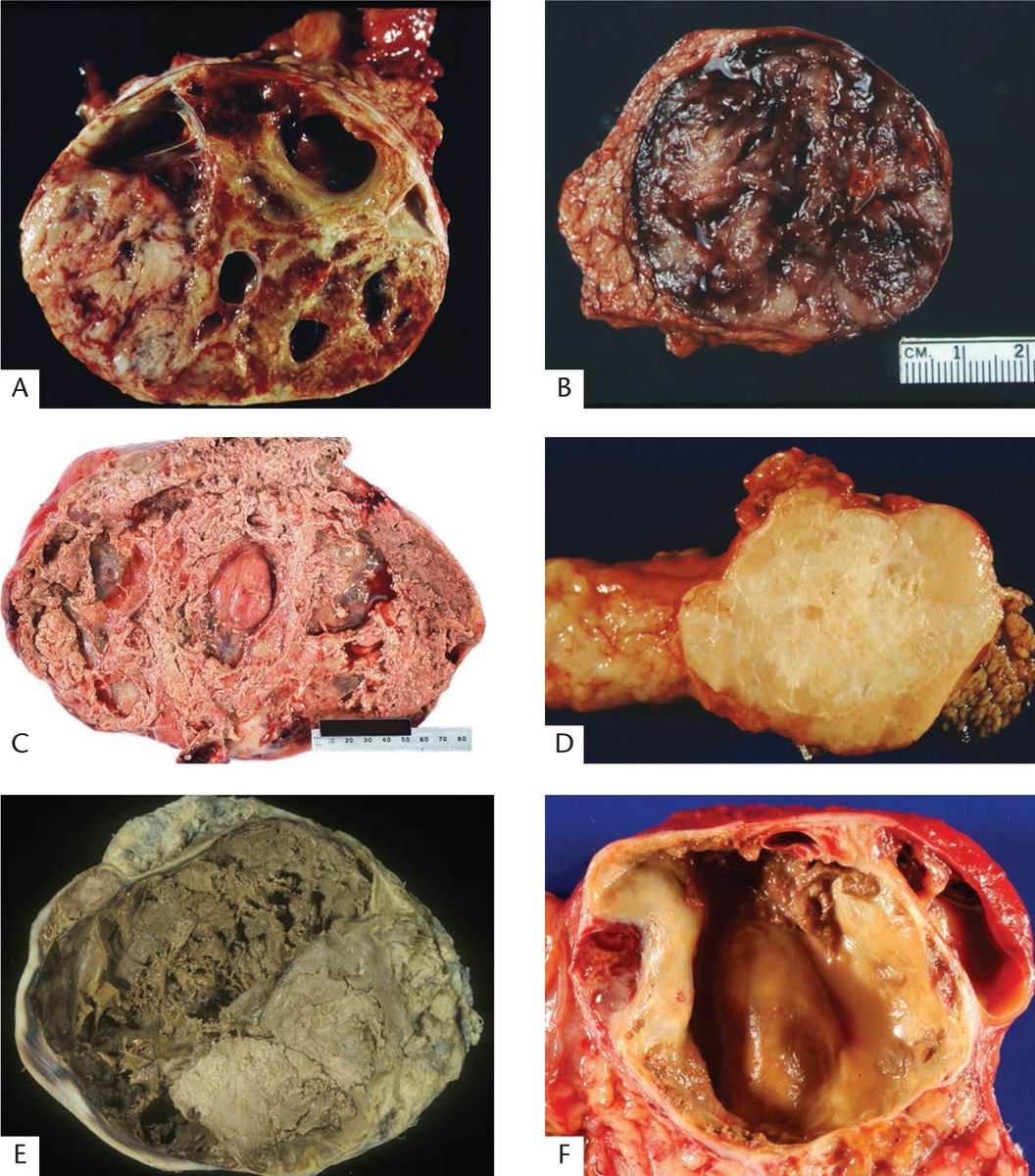 More from the pancreas fascicle (arppress.org): Solid pseudopapillary neoplasm (SPN) is a rare tumor (1-3% of pancreas neoplasms) classically seen in young women which is variably solid to cystic. More on SPN later this week! #GIpath