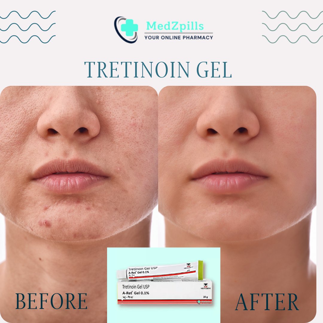 EmmaMac55813900's tweet photo. 🧖‍♀️🔝 Want to clear up acne-prone skin? Here are the top 10 products you need in your skincare routine. And don't forget about Tretinoin gel – it's a game-changer! #Skincare #AcneProneSkin #ClearSkin #Tretinoin
https://t.co/hPdMPnqUk7 https://t.co/mNt3HyVfyO