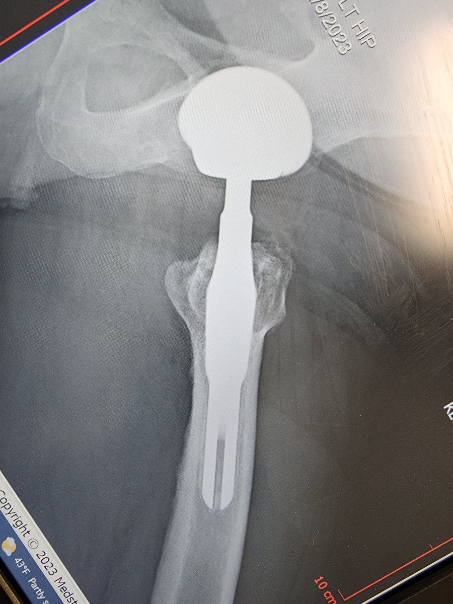 #orthotwitter, 
Help identifying these implants. Done in 2011 for AVN. Looks somewhat like Omnilife dual modular stem. Out of state hospital no longer keeps the records. Cobalt elevated to 1.3, Chromium normal.