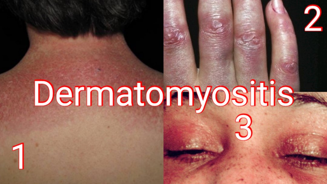 Signs in Dermatomyositis:
1-Shawl sign
2- Gottron papules
3- Heliotrope rash
#SpotDiagnosis #MedTwitter #MedEd #Dermatology #Rheumatology