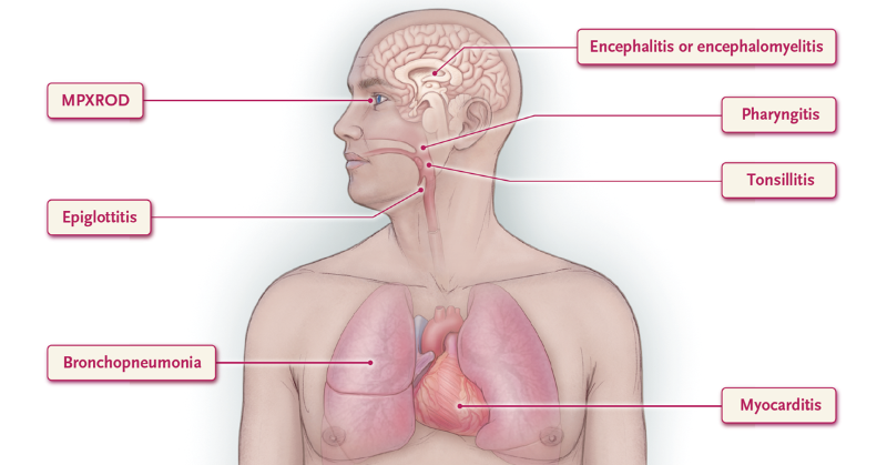 NEJM's tweet photo. Figure 4. Extracutaneous Manifestations of Mpox. https://t.co/x43clrttzo