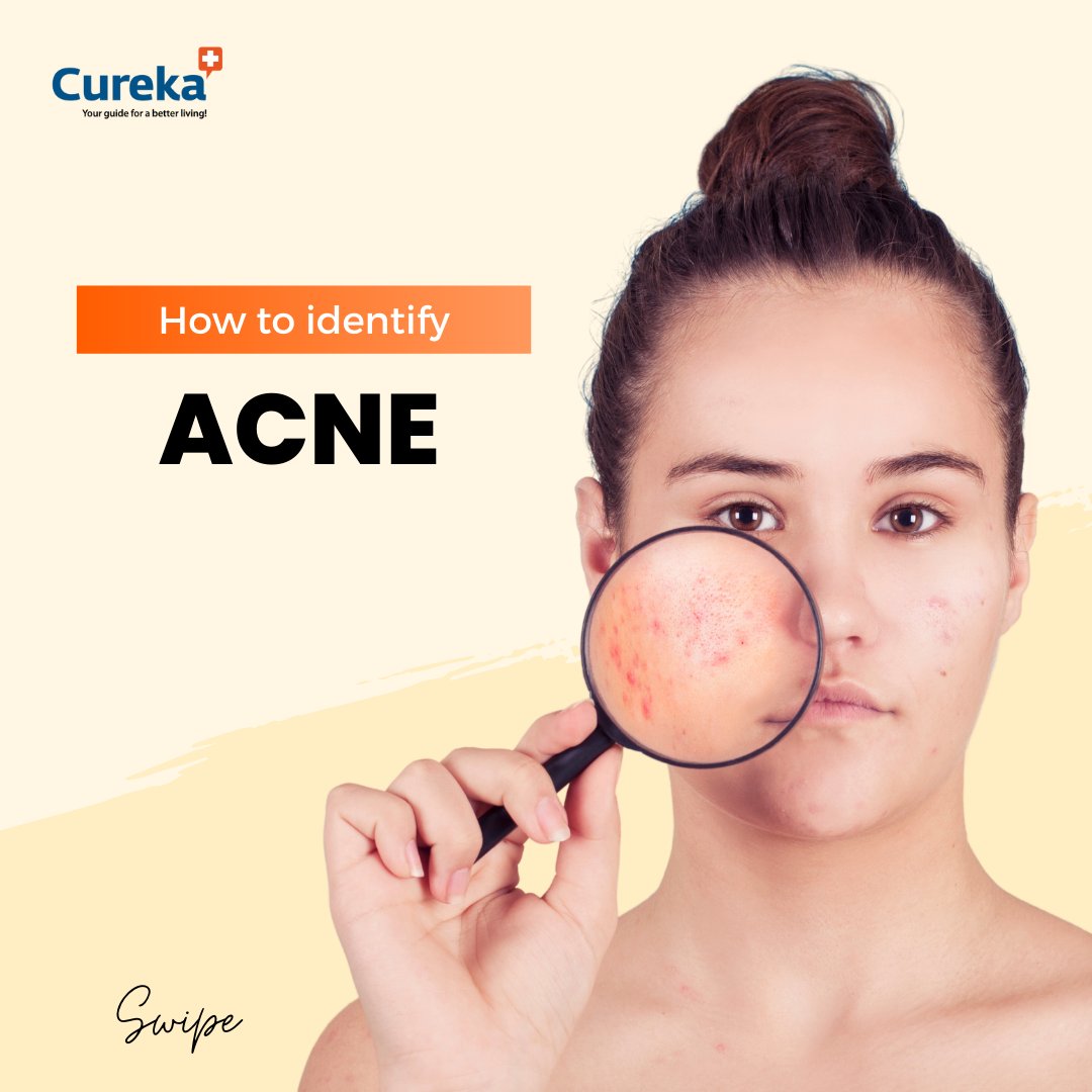CurekaOfficial's tweet photo. Check out Cureka for more information
-
#acne #acnetreatment #acnetreatment #acnerelief #acne #acneremedy #acneremoval #acneproblems #pimples #skin #skinproblems #dryskin #oilyskin #skintreatment #skinhealth #skinproblem #Cureka https://t.co/mu8DNnpCjo