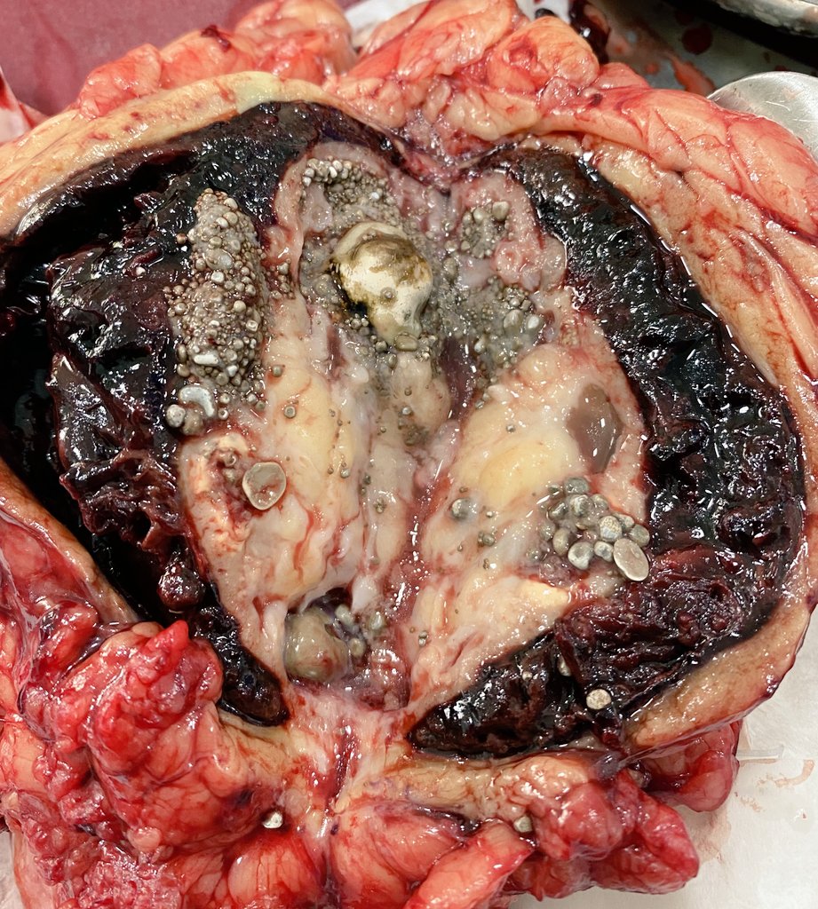 DocGauhar's tweet image. 🙏@DrKScotland @Pathogens_MDPI
 @SiiUrology 
#XGP 🌎part1 #multicenterstudy 
 @D_Castellani @endouro @wroclawski_uro @drabhaymahajan @DrPNMaheshwari @HegeltS @IvanRoblesTorr2 @ArvindGanpule @MPUHUroNephrol @drragoori @ytanidir @Urologeman @colmexurologia  @ManiMriganka @jteoh_hk