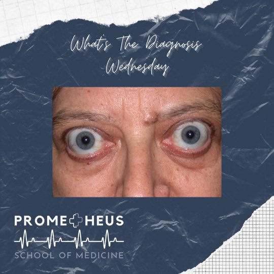 Prometheus_Med's tweet photo. Today is “What’s the Diagnosis Wednesday”! Comment below what you might think the diagnosis is before swiping to see the answer! 
•
•
#medicine #diagnosis #prehealth #wednesday #physician #medicine #doctor #nurse #physicianassistant https://t.co/FFDIu2SQre