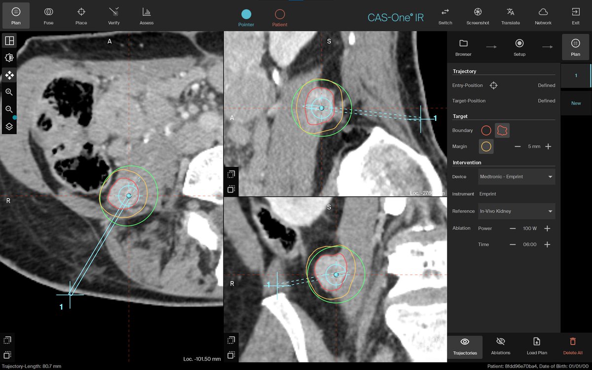 CAScination's tweet photo. Another interesting case!
This patient had a history of RCC with nephrectomy of left kidney with multiple metastases. Latest metastasis in the right psoas.
The ablation zone was adjacent to the colon with an angulated trajectory was precisely planned with CAS-One IR. https://t.co/cDFhVtg7zt