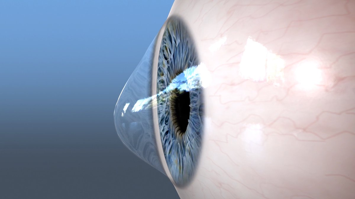 ow.ly/7sGT104GtGy ow.ly/R8R3104GuUl IKA Keratoconus Symposium 2023: Strategies for early diagnosis - Optometry Times