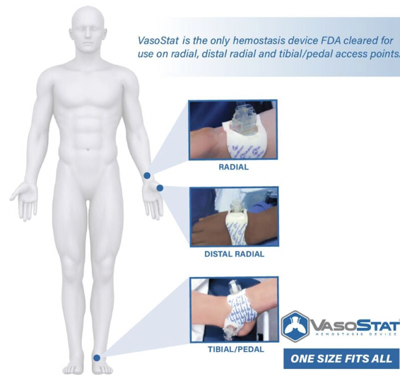 ForgeMedical's tweet photo. How many different size products are filling up your shelf space in the #cathlab? #VasoStat just completed yet another successful eval where we replaced 4 different SKUs with our one size fits all VasoStat #hemostasis device.
.
.
#simplify #radialfirst #pedalfirst #compression https://t.co/e3Da3yoa1L