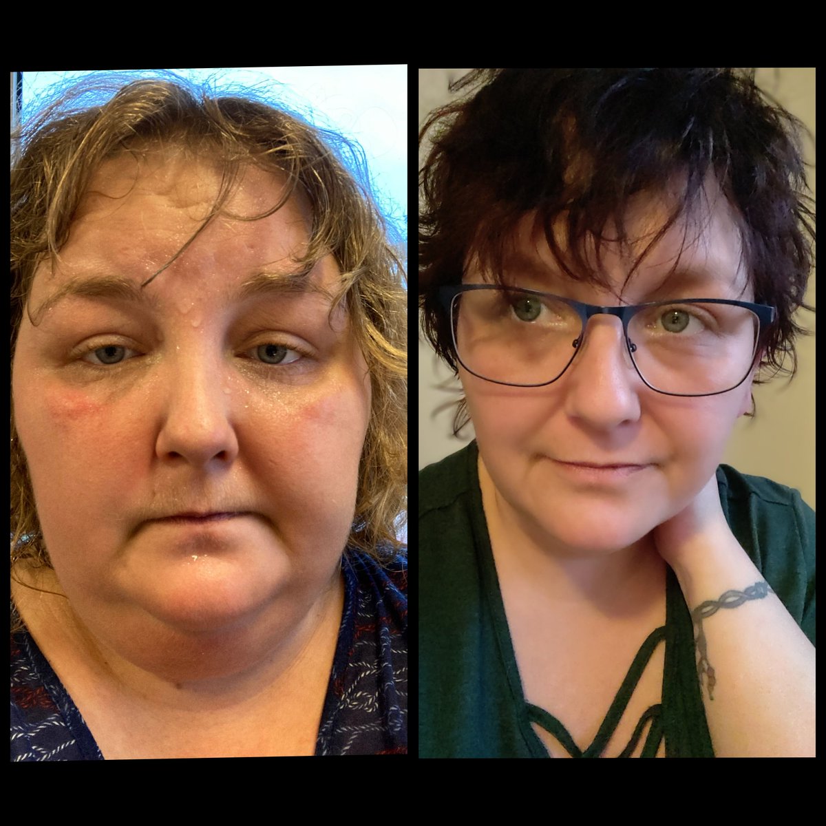 RoamingSerenity's tweet photo. Well. this is me; both pictures. The first is from 2020, when my sarcoidosis was the battle of my life. I doubled my weight in just 2 years because of medication.
The other one is from the other day; never stop fighting and never stop believing.
#sarcoidosis #weightloss #cannabis https://t.co/lyCDM9ZEpQ