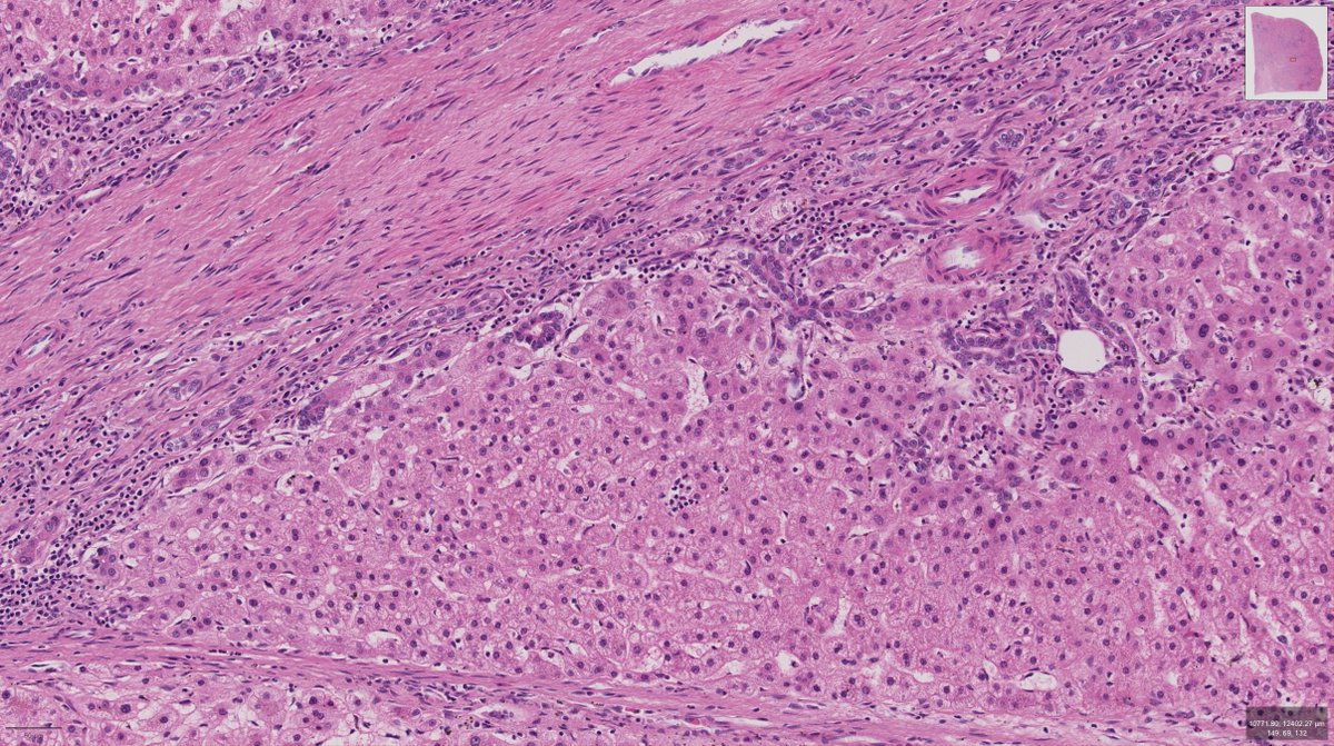 An incidental liver mass in a young woman. This is a classical example

#pathology #GIpath #LiverPath #HBPPath #hepatology #PathTwitter