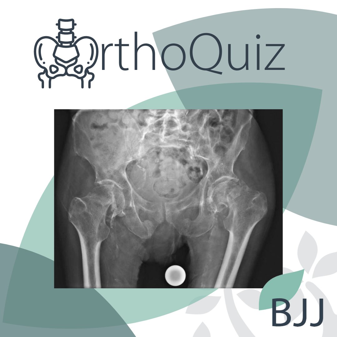 Bone & Joint on Twitter "RT BoneJointJ ORTHOQUIZ 🦴 A 74yearold