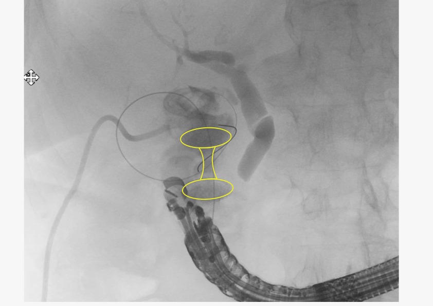 Belenmm271's tweet photo. Today we arrived the #400Axios in our Endoscopy Unit @EndoscopiaH 🥳🥳 So many incredible procedures that improve quality of live in patients with this revolutionary stent 🌟🤩 #EUSinLove #TherapeuticEUS 

Pic: GBD-EUS as internalization of PT drainage in a non-surgical patient https://t.co/ImZfKI9rhc