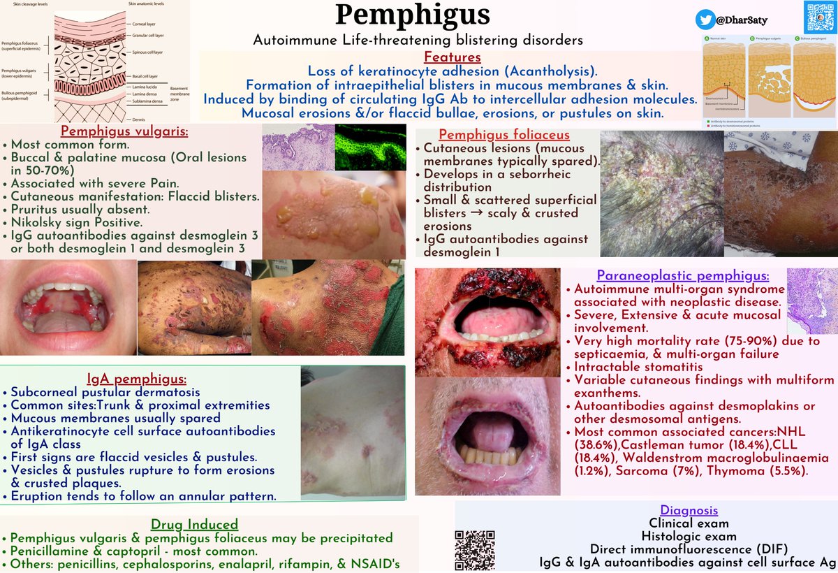 Pemphigus vulgaris (PV):

👉An autoimmune, intraepithelial, blistering disease affecting the skin and mucous membranes. 
👉Mediated by circulating autoantibodies against keratinocyte cell surfaces. 

👉Drug-Induced PV:
Penicillamine
Captopril 
NSAID’s
Penicillin
Cephalosporins