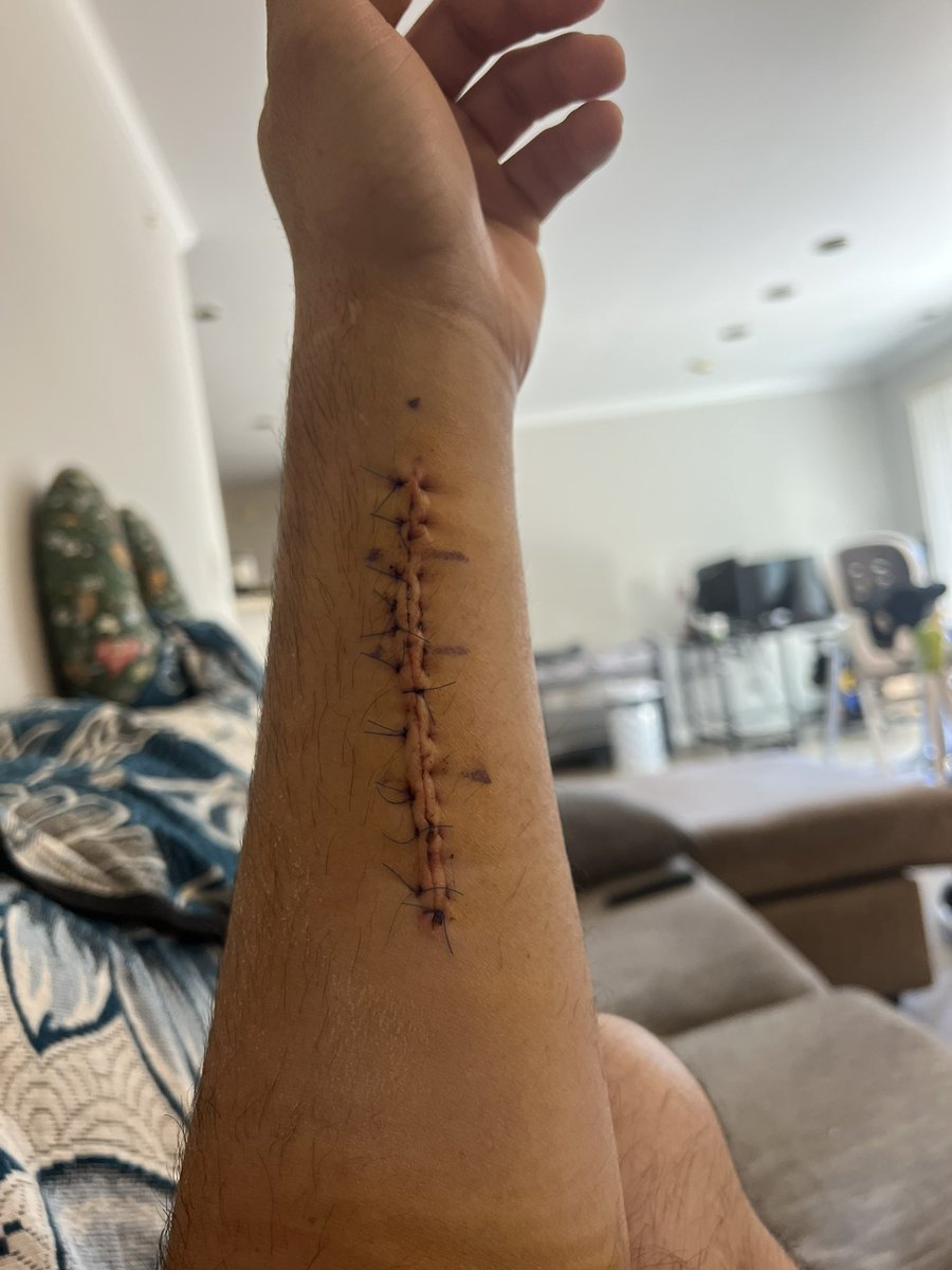 One week down ✅ arm feels great and we are on the road to recovery!  Don’t know what my future holds but I’d be excited to race some outdoors!