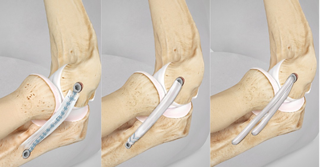 aossmjournals's tweet image. Lateral ulnar collateral ligament repair with #InternalBrace augmentation increases rotational stiffness relative to the intact elbow for restoring posterolateral stability to the native state. Check out the latest research in AJSM!  ow.ly/FvGp50OkIwQ