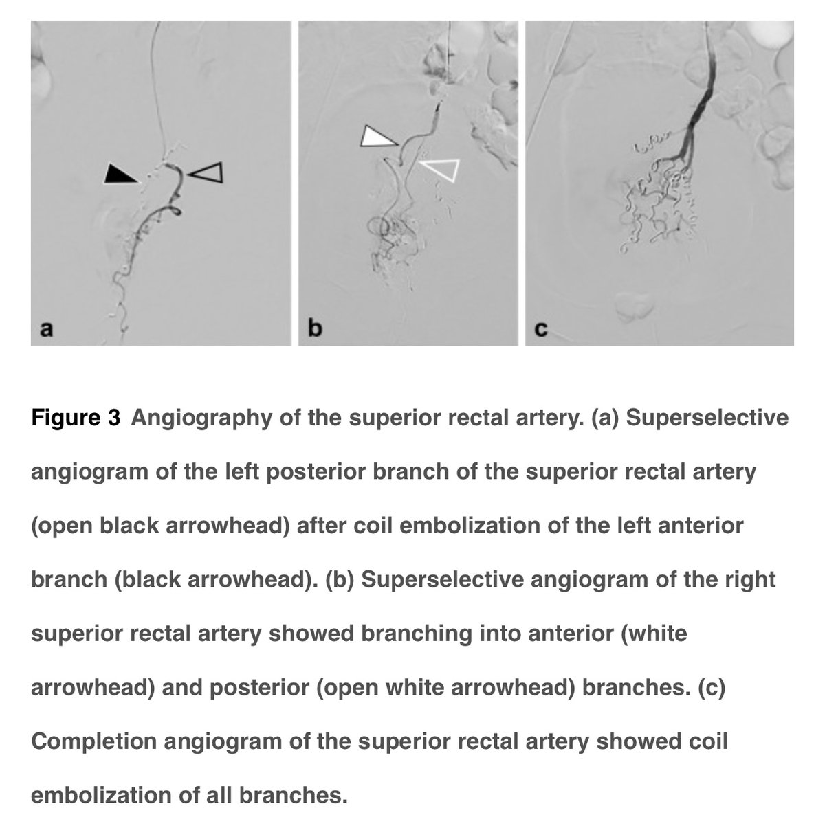 JVIRmedia's tweet photo. Embolization of the Superior Rectal Arteries versus Closed Hemorrhoidectomy (Ferguson Technique) in the Treatment of Hemorrhoidal Disease: A Randomized Clinical Trial

https://t.co/hk04wQobsE https://t.co/g8B7urZfhJ