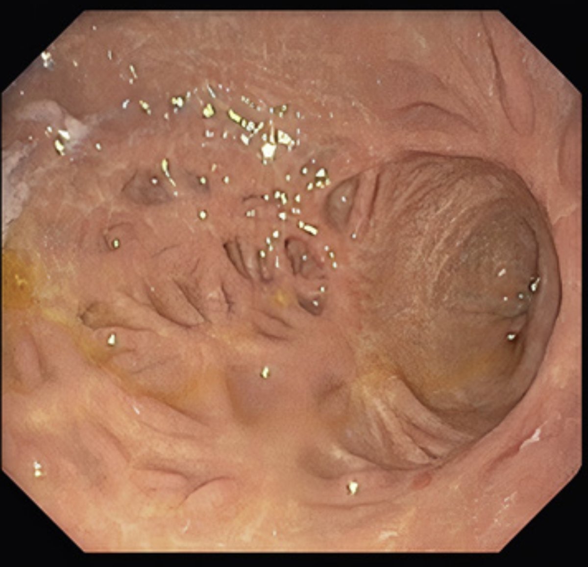 drkeithsiau's tweet photo. Endoscopic appearance of the stomach. What’s the diagnosis? https://t.co/owbHpD6JBl