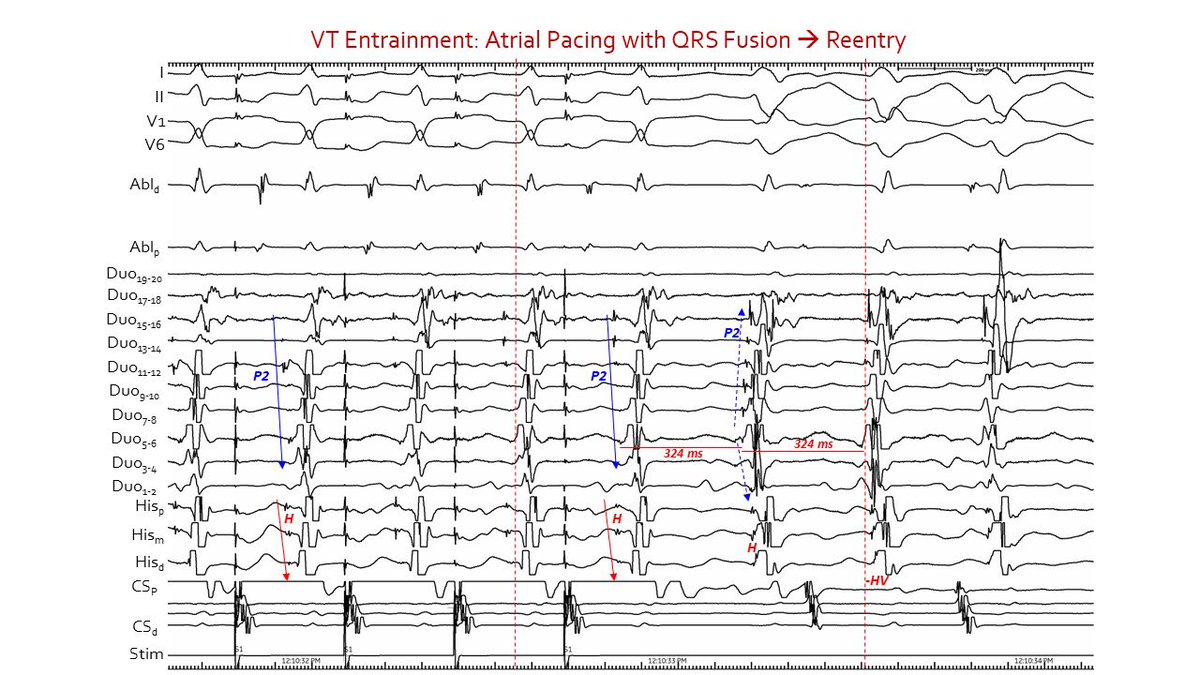 HHsiaMD's tweet photo. Young woman with incessant spont VT, sinus resets VT, A entrains with near identical QRS as Apace, circuit involves septal fascicle, LAF &amp; LPF are bystanders https://t.co/WBSWDWk7lZ
