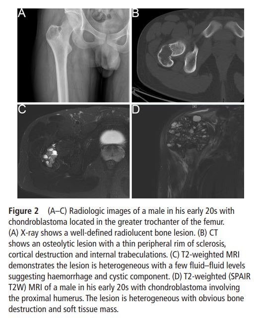 JClinPath_BMJ's tweet photo. 👇#OriginalResearch #EditorsChoice #June2023
🔥 New #BSTpath article alert! 🔥
"Chondroblastoma: clinicopathological analyses of
307 cases from a single institution in China and the
diagnostic value of the H3F3 K36M mutant antibody"
by Zhao et al.
https://t.co/sXuWABMOQp https://t.co/Du2pwMWvqS