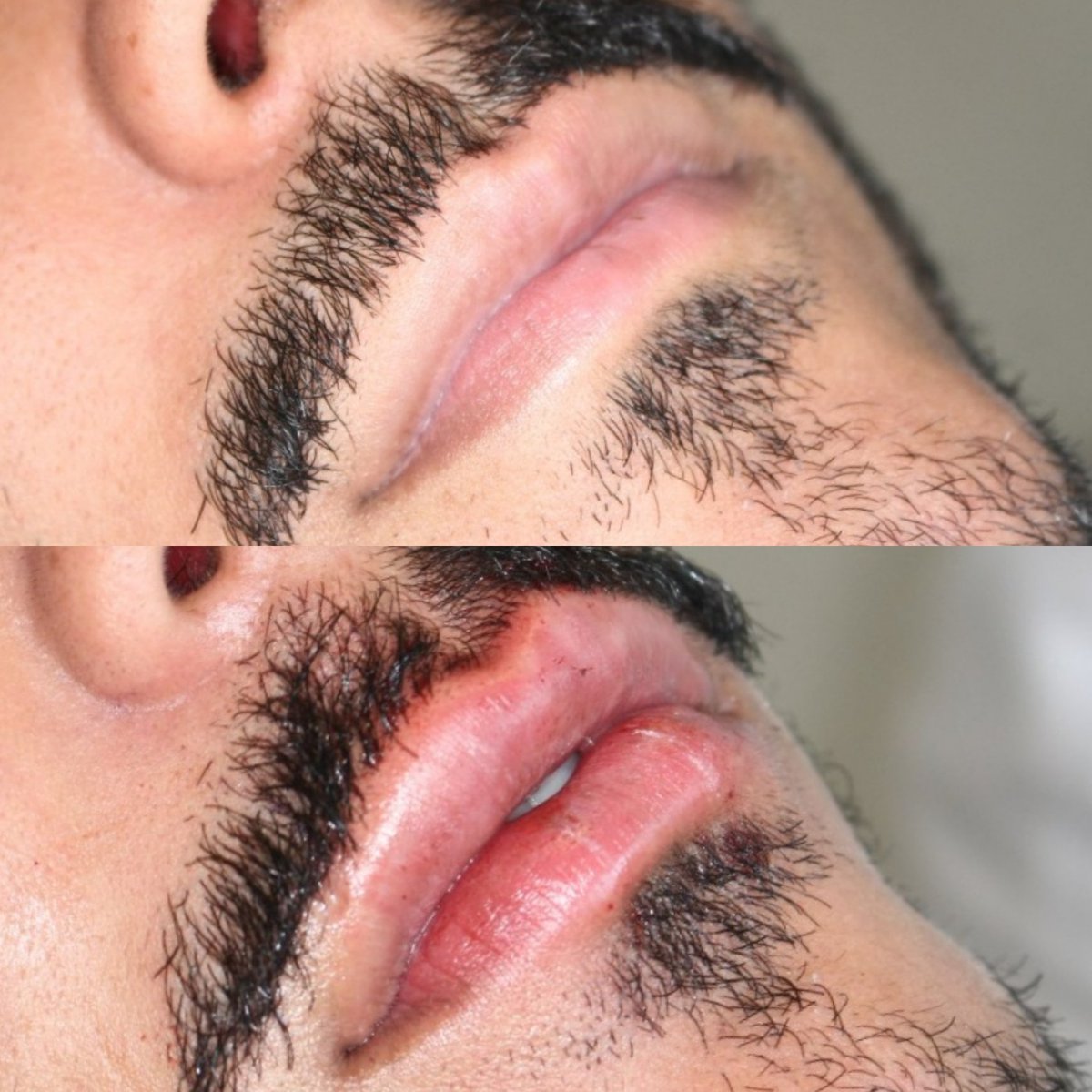 AmandaLacerda's tweet image. Antes e depois de um preenchimento labial masculino #preenchimentomasculino #preenchimentolabial