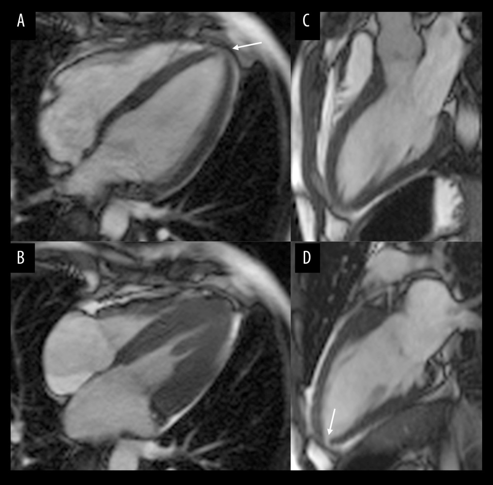 Sports_CardioNL's tweet photo. An interesting SportsCardiology case!
Reversible Apical Hypertrophy in a Young Competitive Athlete with Familiar Hypertrophic Cardiomyopathy https://t.co/xPXTX0Rf6v
#SportsCardiology #HCM #athlete #detraining https://t.co/EnliZWjvMk