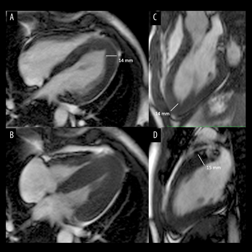 Sports_CardioNL's tweet photo. An interesting SportsCardiology case!
Reversible Apical Hypertrophy in a Young Competitive Athlete with Familiar Hypertrophic Cardiomyopathy https://t.co/xPXTX0Rf6v
#SportsCardiology #HCM #athlete #detraining https://t.co/EnliZWjvMk