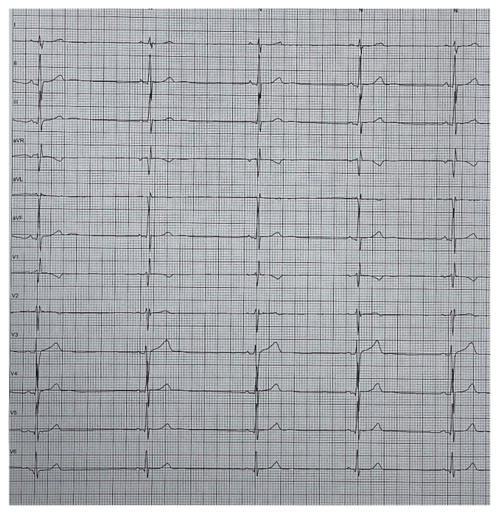Sports_CardioNL's tweet photo. An interesting SportsCardiology case!
Reversible Apical Hypertrophy in a Young Competitive Athlete with Familiar Hypertrophic Cardiomyopathy https://t.co/xPXTX0Rf6v
#SportsCardiology #HCM #athlete #detraining https://t.co/EnliZWjvMk