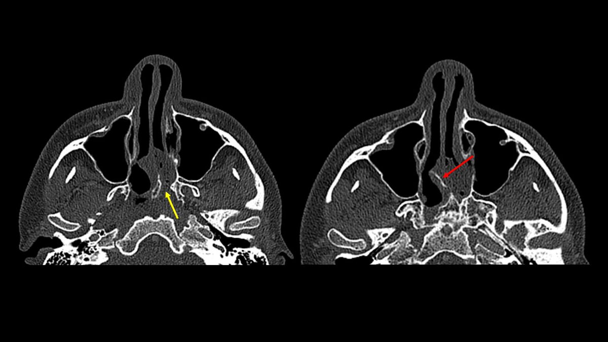U/L nasal pus=broad DDx...often, BUT not always #ODS! Saw this nasal 'trickery' yesterday. Adult had chronic left nasal obstr and drainage; prior partial septoplasty (red) but no better; no preop endoscopy! Moral: SCOPE &amp; SUCTION, DON'T MISS #choanalatresia (yellow) <a href="/henryfordent/">Henry Ford ENT</a>