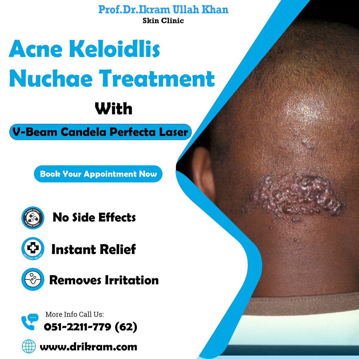 Say goodbye to Acne Keloidalis Nuchae with the powerful V-Beam Candela Perfecta laser! 🌟
Book an appointment with Prof. Dr. Ikram Ullah Khan Skin Clinic 
Call us at 051-2211779,051-2211762,0334-8582829

#AcneKeloidalisNuchae #VBeamLaser #ProfIkramUllahKhan #ClearSkin #Confidence