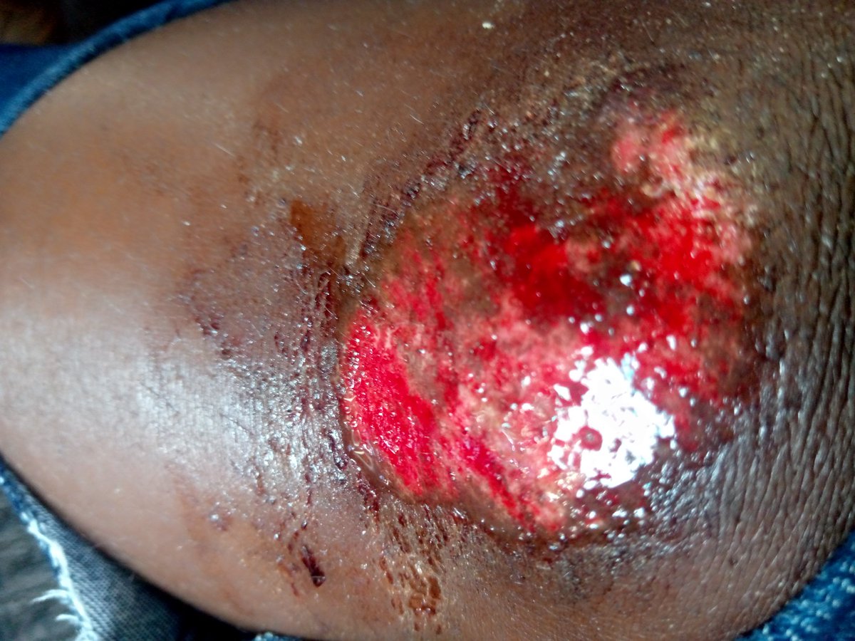 BlandiaKulaba2's tweet photo. Je viens d'être victime de la barbarie du régime tshilejelu, fortement  tabassée par les policiers sans cœurs.
Les signes d'un régime qui tend vers sa fin,nous n'allons pas nous laisser faire et surtout nous sommes déterminés à lutter jusqu'à la dernière énergie pour qu'il parte. https://t.co/affjRlSMgj