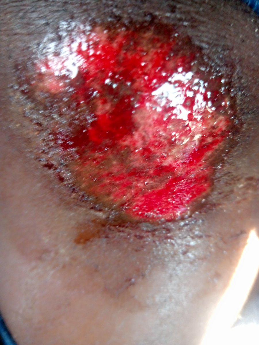 BlandiaKulaba2's tweet photo. Je viens d'être victime de la barbarie du régime tshilejelu, fortement  tabassée par les policiers sans cœurs.
Les signes d'un régime qui tend vers sa fin,nous n'allons pas nous laisser faire et surtout nous sommes déterminés à lutter jusqu'à la dernière énergie pour qu'il parte. https://t.co/affjRlSMgj