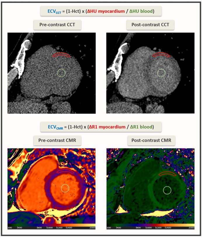 Did you know #yesCCT can be utilized to quantify ECV? Baggiano et al. demonstrated the feasibility with a whole heart single source, single energy CT scanner in the context of newly diagnosed LV dysfunction. ow.ly/CzaU50OraIK