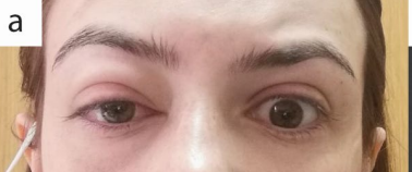 A previously healthy 28 year old female with Superior Ophthalmic Vein Thrombosis and Thrombocytopenia  Following ChAdOx1 nCoV-19 #AstraZeneca Vaccine
pdfs.semanticscholar.org/a17b/fa116998a…