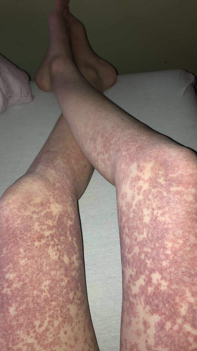 VoicesUnheard's tweet photo. "Today marks one year since I made one decision that turned out to be the worst decision I’ve ever made. Getting the HPV vaccine ruined my life. I have not been the same since.

 24 hours after I got the vaccine I started breaking out in hives and my throat was closing up. Ive broken out in hives 3 times and almost died twice from my throat closing up and high fevers. I’ve had over 15 trips to the hospital and been hospitalized 3 times. Ive had doctors tell me they didn’t know what was going on with me and that I’m lucky to be alive. I’ve had mononucleosis, 2 sinus Infections, Flu A, Flu B, and bronchitis from how terrible my immune system has become. I had surgery to get my tonsils and adenoids removed.

 I’ve lost over 15 pounds. I’ve seen over 10 doctors. I had one tell me it was all in my head. I’ve missed months of school and I missed last years prom. I’ve lost friends. I was in the hospital on Easter. I’ve had over 20 IV’s. I’ve been in pain every single day.

 After a few months of being very sick I was then diagnosed with POTS and chronic migraines. You can get POTS after a bad infection. Yes I did have a few doctors agree that the vaccine caused this and I have a vaccine attorney that agreed to take my case. 

Please do your research on this vaccine. There’s no known cases that it actually stopped someone from getting HPV. Getting HPV can be treated, but what’s happened to me and many other people, is not treatable! People have died from this shot! Getting the vaccine is a gamble, and personally I think the risks outweigh the benefits. Please share for awareness. 

I’m extremely thankful for the people who have stayed by my side and have helped me. I couldn’t of done it without them. 

I’m working everyday to get back to the life I once had. 

I do have a YouTube video explaining everything in a lot more depth! Click on the link. 🖤
https://t.co/IviOkJNHas