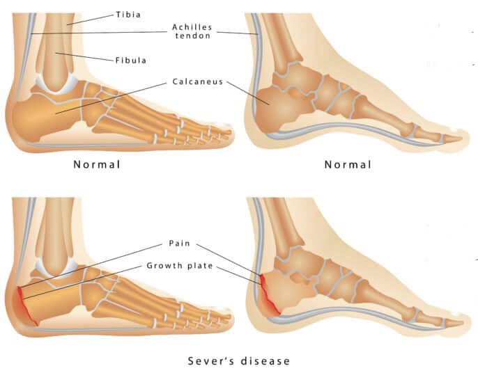 Sever’s Disease (Calcaneal Apophysitis) occurs in up to 16% of all MSK issues with children but it is challenging to manage so let’s that a closer look 🧵1/5