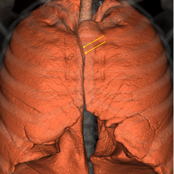 Anterior junction line on CXR and CT. Line forms where the pleura meets anteriorly.
#FOAMed #radres