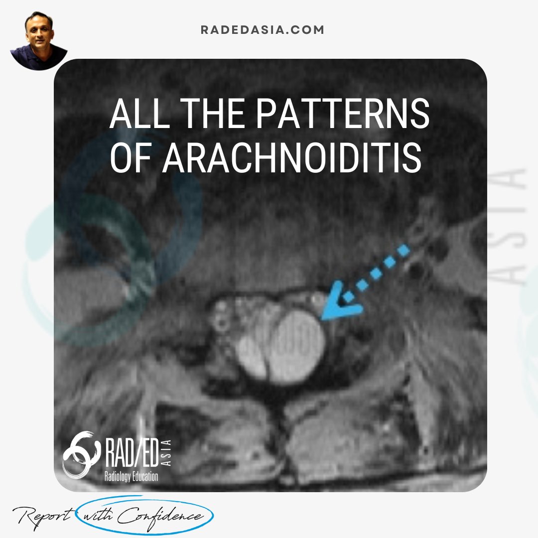 Arachnoiditis can have many appearances but there are patterns we can recognize to make the Dx on MRI.  
Follow the link to see what they are: bit.ly/arach01
#radiology #radedasia #spinemri #radiologia #rheumatology #spinearthritis #arachnoiditis #lumbarspine #Cord
1/n