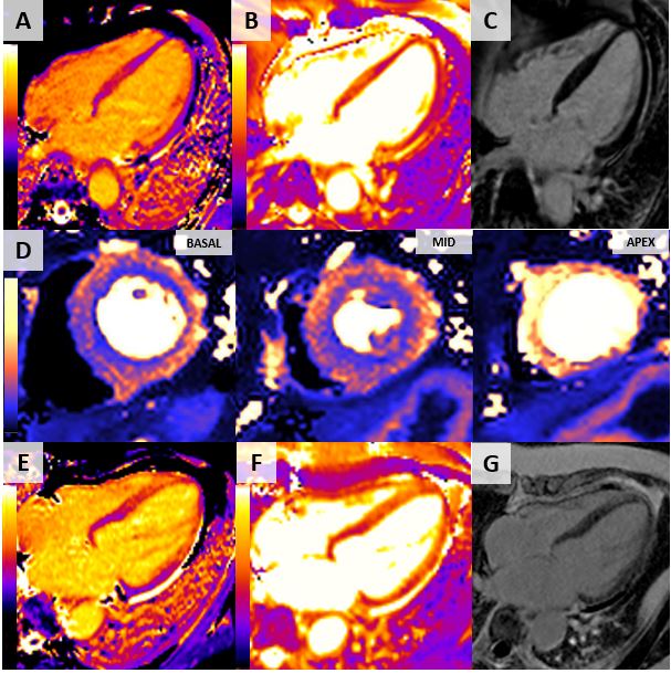 Tako-Tsubo syndrome or broken heart syndrome💔. Check out our unique case @ESC_Journals and the importance of CMR mapping and the additive value of quantitative perfusion maging.

doi.org/10.1093/ehjci/…

#EHJCVI #whycmr @sterosmini @BromageDan @sado_dan @_antocannata