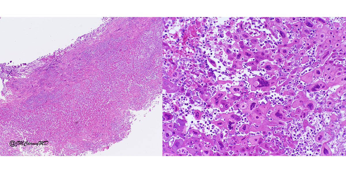 Nice example of this entity... tracheal ulceration in a patient who previously underwent heart transplantation @ATDeyrupMDPhD @KMirza @DrSMBean @Sara_Jiang