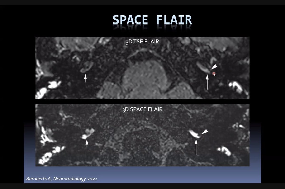Dr Bernaerts provides a nice introduction to the technique used for hydrops imaging - Gd passes the blood perilymph barrier. Heavily T2W SPACE FLAIR is optimal #hnrad #radiology #menieres @BSHNI_UK @ASHNRSociety