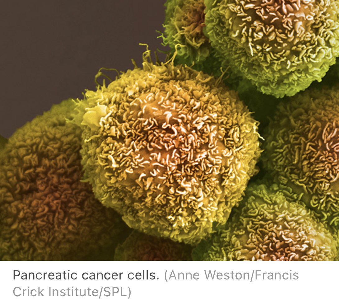 carol_perelman's tweet photo. 🎉No podemos dejar de celebrar la GRANDIOSA noticia contra uno de los cánceres mas letales (88%!):

👉🏻La vacuna de RNAm PERSONALIZADA💉-hecha a partir de cada tumor- evitó recaída del cáncer de páncreas en 50% de los 16 participantes a los 18meses!🙏🏻🙌🏻👏🏻

 https://t.co/kJbfxcGWZr https://t.co/FTAHSAPFoj